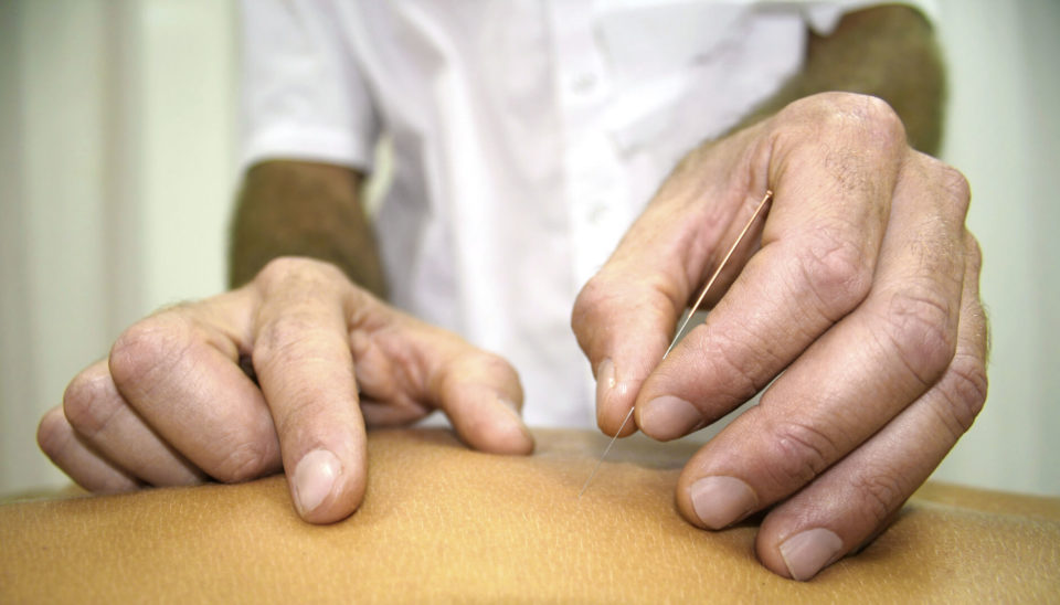 chinese-medicine-treatment-close-up-of-hands-doing-acupuncture-sportreat-services-dry-needling